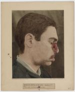 Hôpital Saint-Louis, service de M. le Docteur Besnier - Farcinose mutilante de la face (profil) - Pa [...]