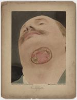 Hôpital Saint-Louis, service de M. le Docteur Ernet Besnier - Trichophytie [recto] - Patient : Tremp [...]