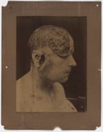 Hôpital Saint-Louis, service de M. le Docteur Ernest Besnier- Syphilides ulcéreuses simulant un épit [...]