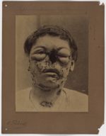 Hôpital Saint-Louis, service de M. le Dr Ernest Besnier . Signé Dr Thibierge - Syphilitides tubercul [...]